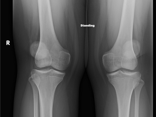 Летеропозиция коленных чашечек рентген
