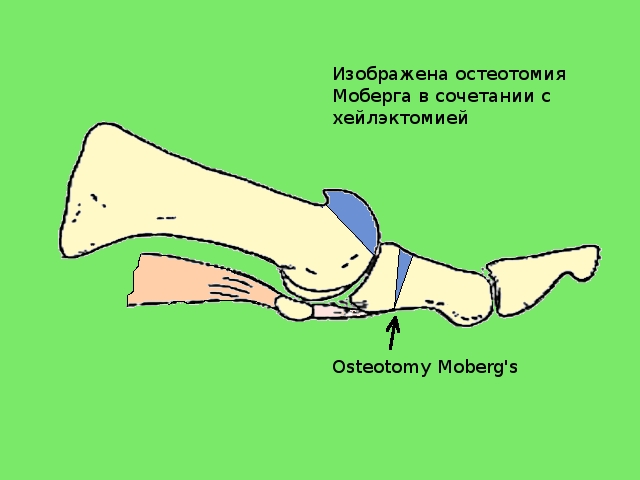 остеотомия моберга