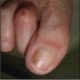 Межфаланговый вальгус, или боковое отклонение ногтевой фаланги