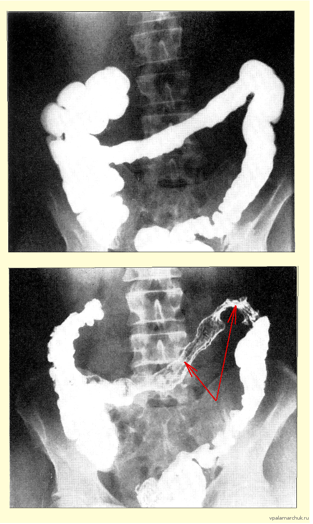 ишемия кишечника рентген с барием