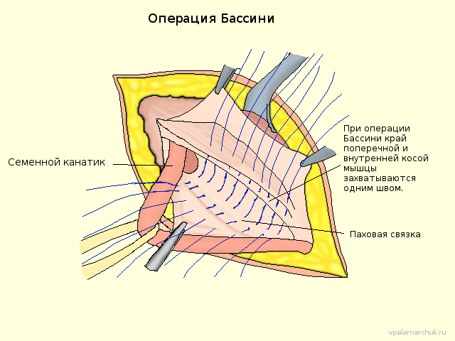 Схема операции Бассини